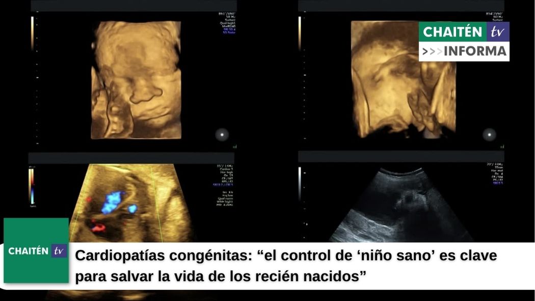 Cardiopatías congénitas: “el control de ‘niño sano’ es clave para salvar la vida de los recién nacidos”